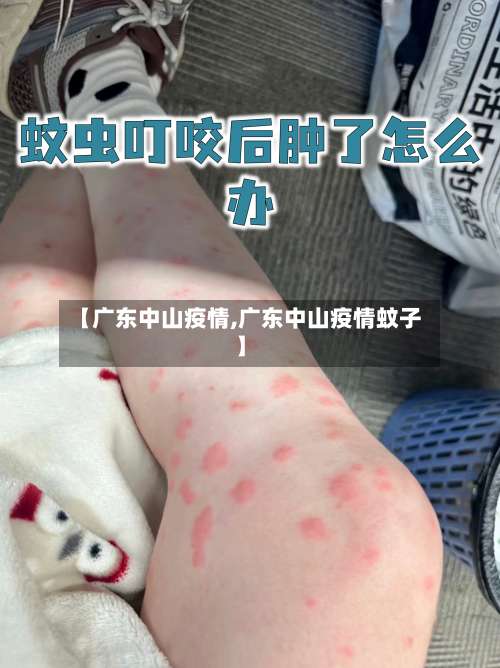【广东中山疫情,广东中山疫情蚊子】-第2张图片