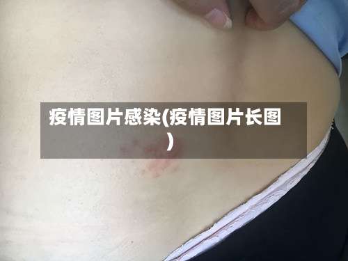 疫情图片感染(疫情图片长图)